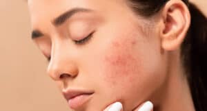 TIPOS de CICATRICES de ACNÉ - ¿Cómo prevenir las marcas en la piel?
