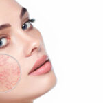 Cómo evitar la sensibilidad de la piel causada por ingredientes cosméticos botánicos
